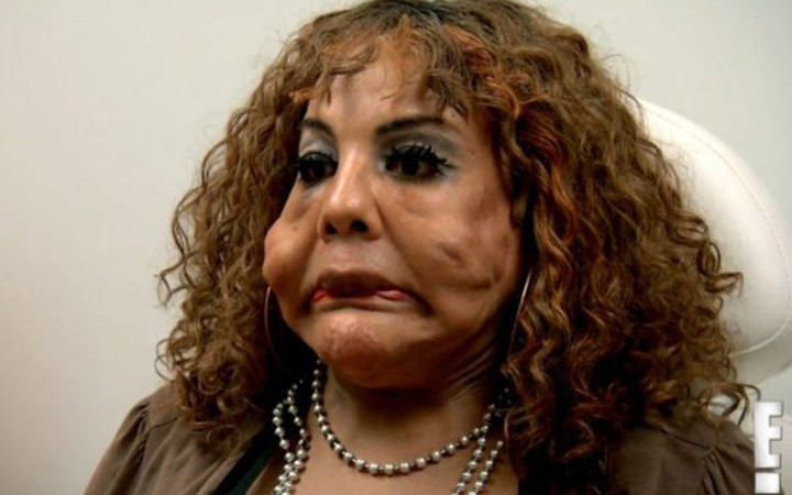 Estetik yaptırayım dedi bu hale geldi sonu ise daha beter