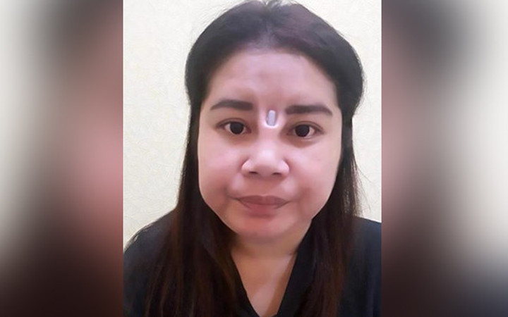 Estetik yaptırayım dedi sonu ise büyük facia!