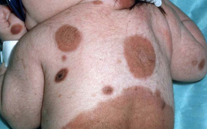 500 doğum lekesi ile doğdu ama  manken oldu