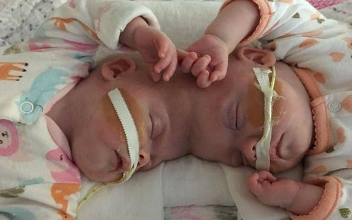 Dünya merakla bekliyordu yapışık ikizler ameliyat oldu