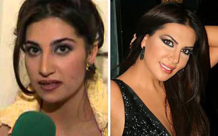 Estetikle müthiş değişen Türk ünlüler