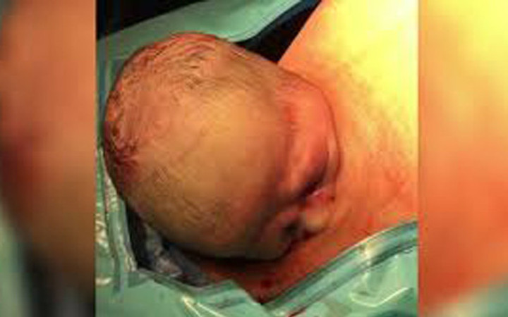 Tüm dünya bu bebeği konuşuyor annesinin karnından kendi çıktı!