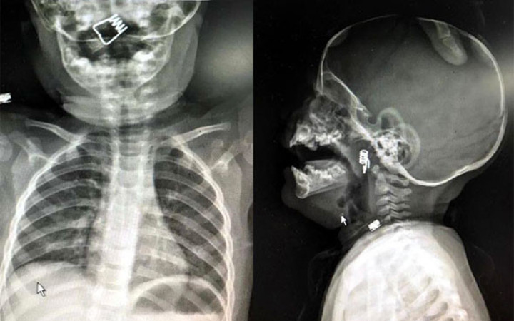 1 yaşındaki bebeğin yuttuğu şeye inanamayacaksınız filmde göründü...