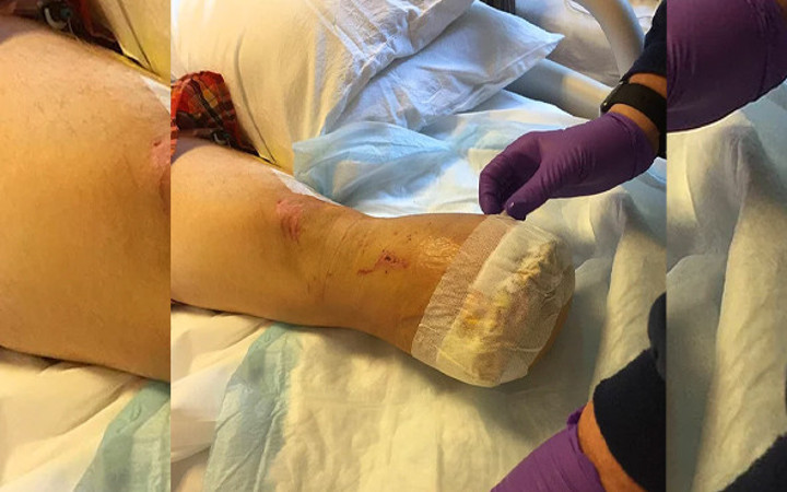 Kazada kopan bacağını pişirip yedi arkadaşlarına ziyafet verdi!