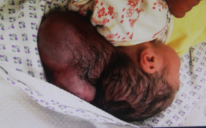 Hatay’da iki kafalı bebek dünyaya geldi