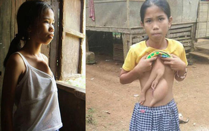 Göğsünde iki kol ile doğdu  şimdi tedavi olmayı bekliyor