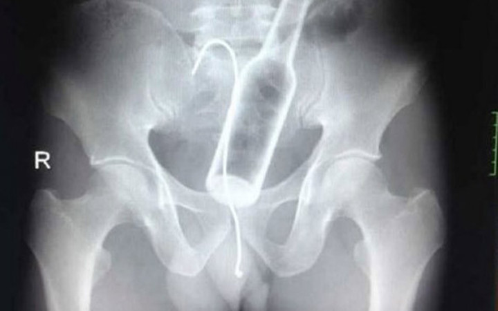 Röntgende her şey görüntülendi! İçine soktuğu şişe mideden çıktı