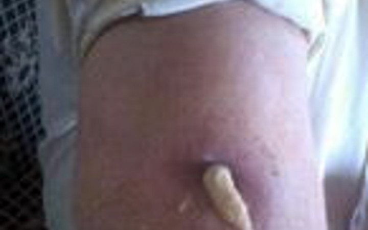 15 yıl kolundaki bezle yaşadı