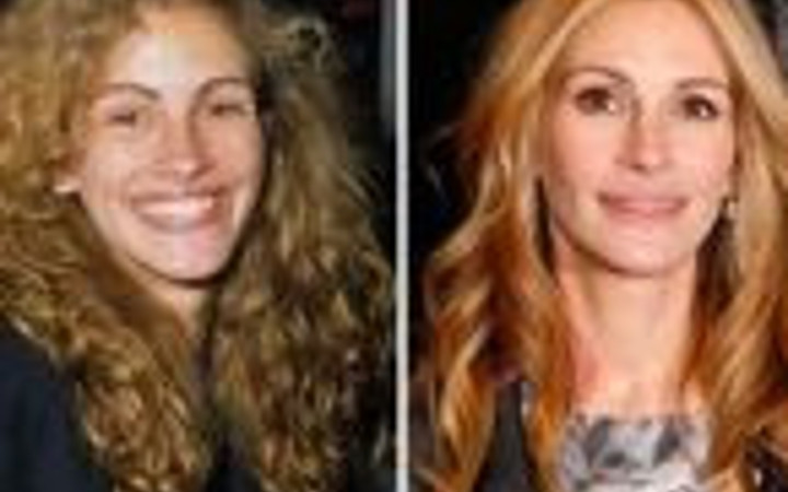 Ünlülerin estetik öncesi ve sonrası