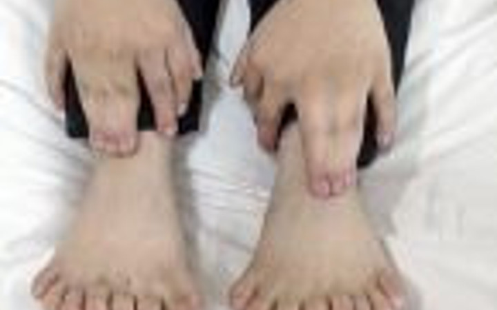 Bu çocuğun 31 tane parmağı var