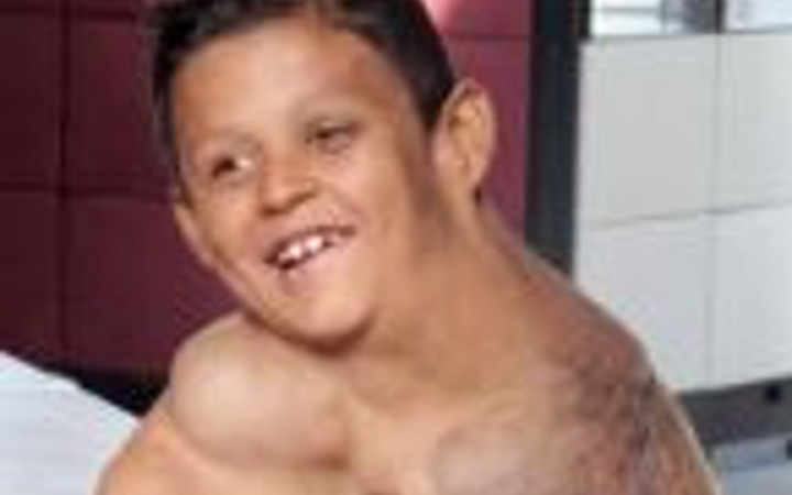 Dev tümör çocuğu bu hale getirdi