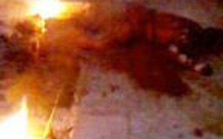 Kendini yakan üniversiteli kurtarılamadı!