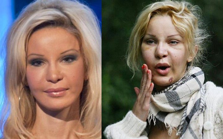 Tam 331 kez estetik oldu ama...