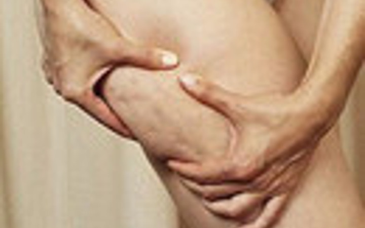 8 adımda selülitten kurtulun!