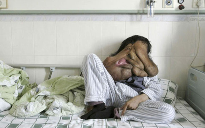 Dünyanın en büyük tümörü