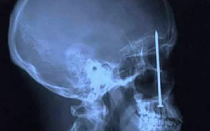 XRay'lerde insanların içinde görüntülenen en acayip şeyler