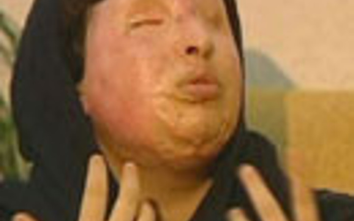 Yüzüne kezzap atıldı