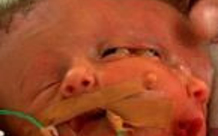 Yapışık ikizler hayata tutunamadı