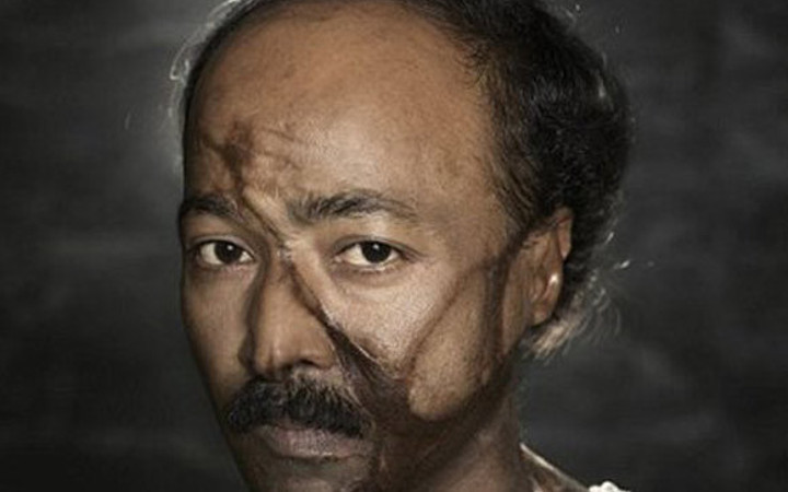 Asit saldırısı kurbanları...