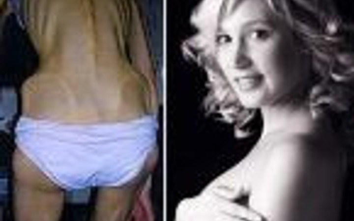 Aşırı zayıf kızlar böyle hayata döndü