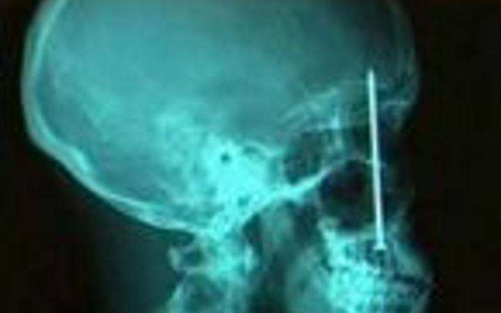 Hayrete düşüren röntgen filmleri 