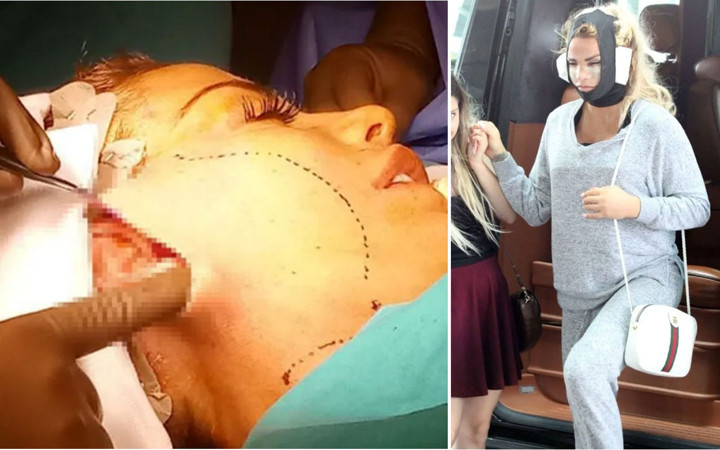 İngiliz şarkıcı Katie Price estetik ameliyatını canlı yayınladı! Sonrası ise korkunç
