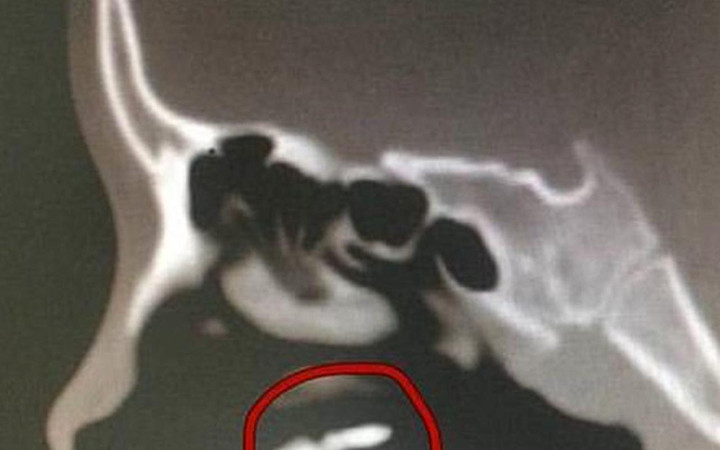 Solunum güçlüğü çektiği gerekçesiyle hastaneye gitti! Burnundan çıkan şoke etti