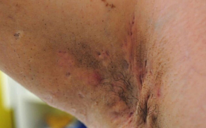 Bu belirtilere dikkat! Koltuk altı ve kasıkta görülüyor!