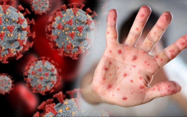 Gana'da M çiçeği vaka sayısı artıyor!