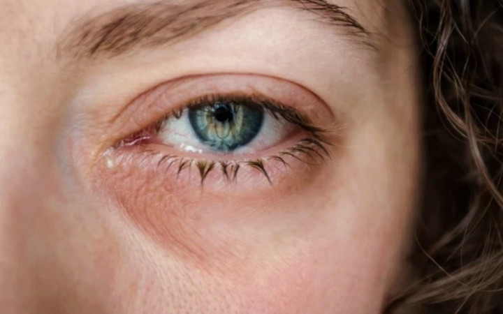 Gözde kaşıntıya dikkat! Bu hastalığın belirtisi olabilir...