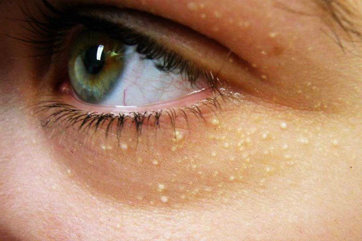 Kolesterolü yüksek olanlar ne yemeli 9 beslenme önerisi! - Resim: 1