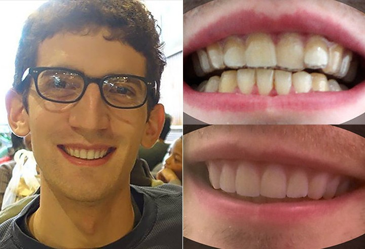 3D yazıcı ile dişlerini düzeltti - Resim: 1