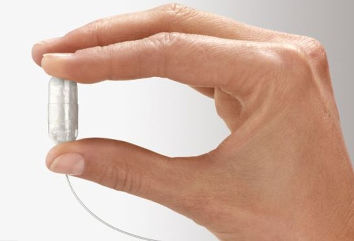 Balon haplarla zayıflamak mümkün mü? - Resim: 2