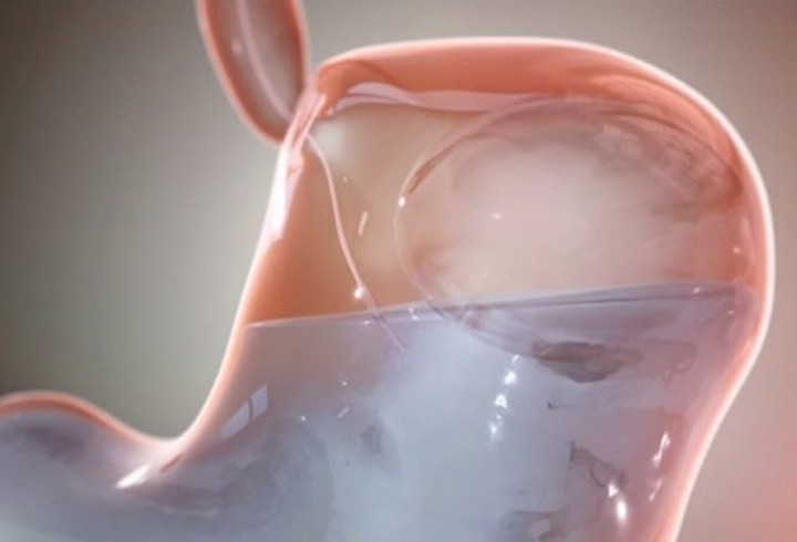 Balon haplarla zayıflamak mümkün mü? - Resim: 3