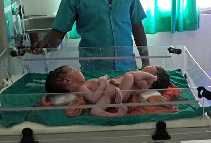 Aynı bedende bir kız bir erkek - Resim: 1