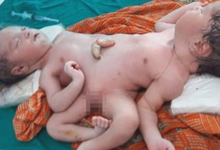 Aynı bedende bir kız bir erkek - Resim: 2