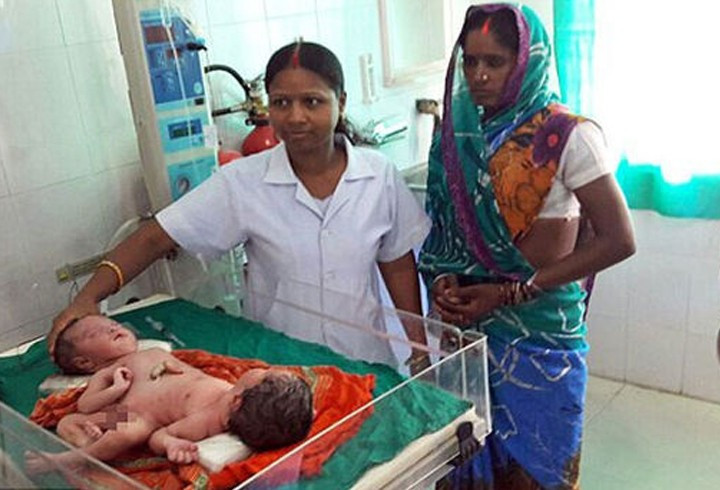 Aynı bedende bir kız bir erkek - Resim: 3