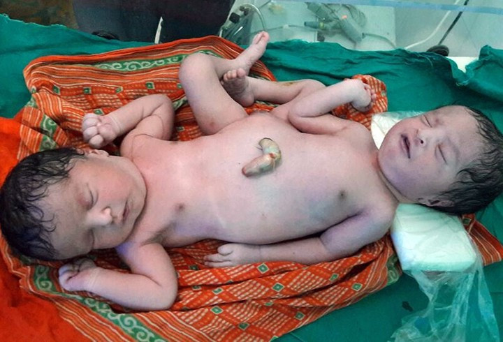 Aynı bedende bir kız bir erkek - Resim: 4