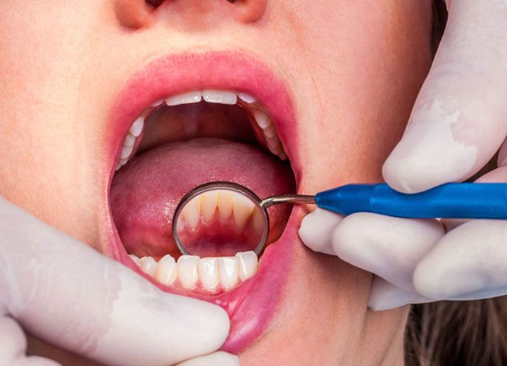 Dişte apse neden olur nasıl geçer? - Resim: 1