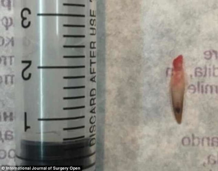 Tırnağının üstünde tırnak çıktı - Resim: 2