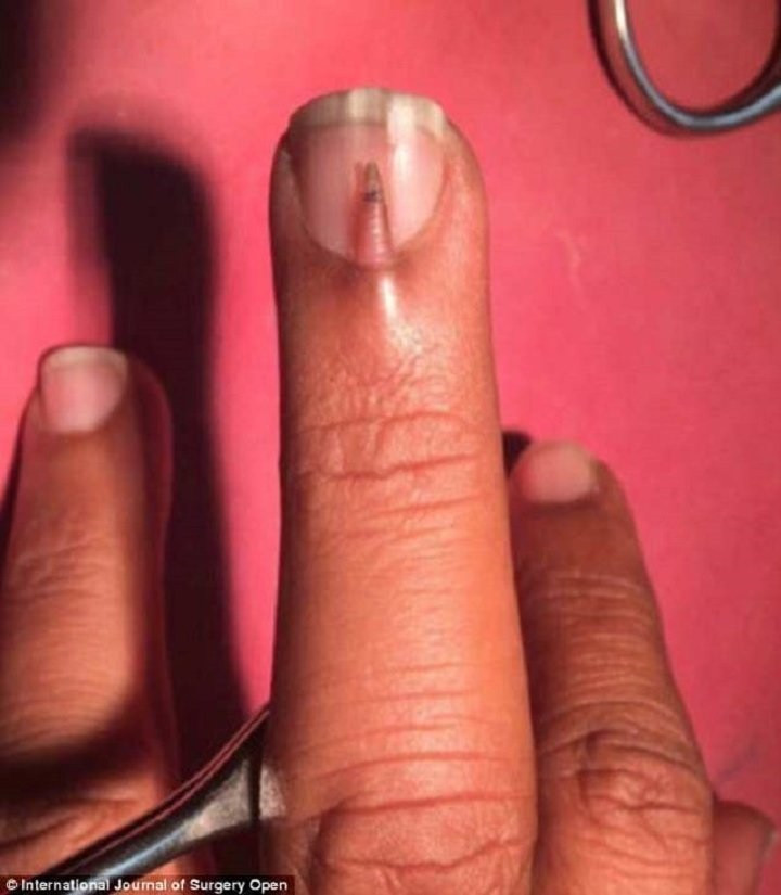 Tırnağının üstünde tırnak çıktı - Resim: 3