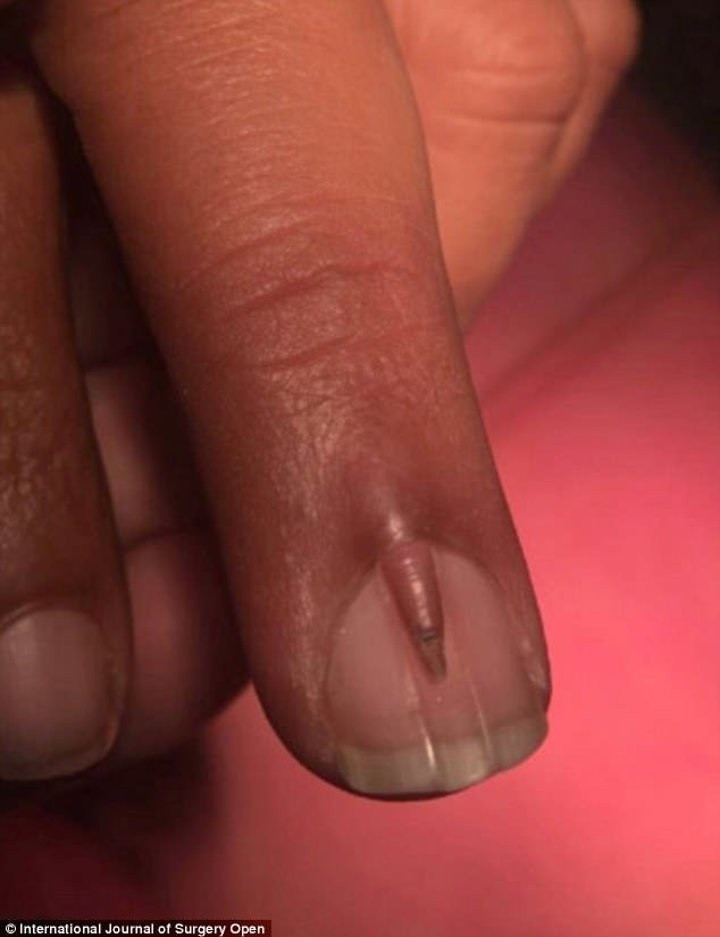 Tırnağının üstünde tırnak çıktı - Resim: 4