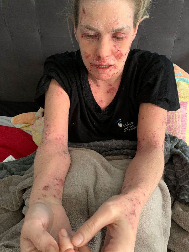 Egzama için kullandığı krem tanınmaz hale getirdi aylarca evden çıkmadı - Resim: 1