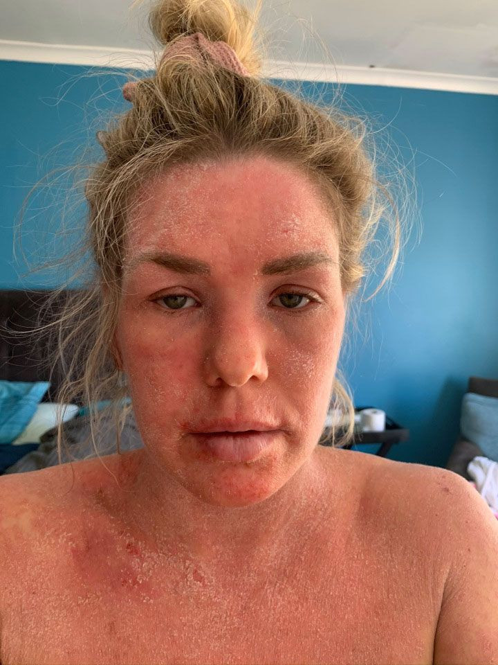 Egzama için kullandığı krem tanınmaz hale getirdi aylarca evden çıkmadı - Resim: 3