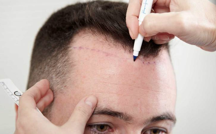 Saç ekimi yapacaklar dikkat! Bu 4 aşamayı dikkate almazsanız... - Resim: 2