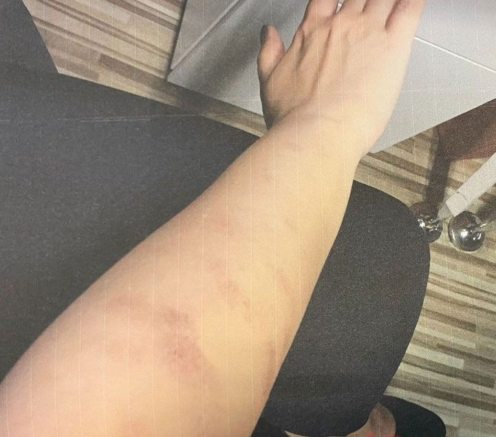 Ünlü şair Ahmet Selçuk İlkan'ın kızlarını yaktılar! Lazer kurbanı kardeşler mahkemeye koştu - Resim: 3