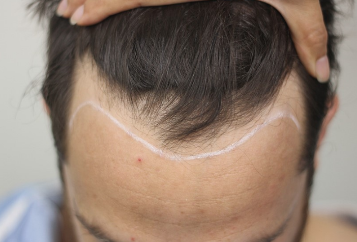 Saç ekimi yapacaklar dikkat! Bu 4 aşamayı dikkate almazsanız... - Resim: 3