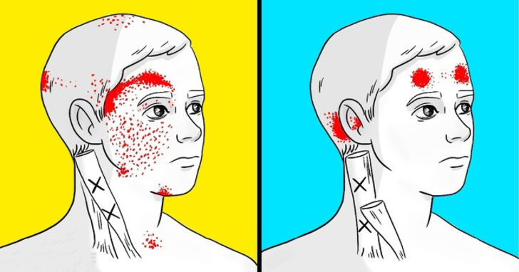 Baş ağrısı ve migreni tetikleyen besinler - Resim: 2