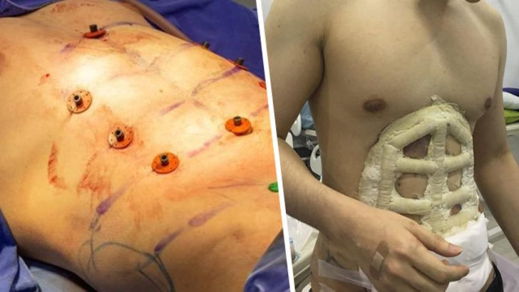 Erkeklerde yeni moda: Ameliyatla baklava yaptırıyor! - Resim: 4