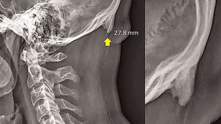 Cep telefonu kullananlar dikkat bu hareket ensede boynuz çıkarıyor - Resim: 2